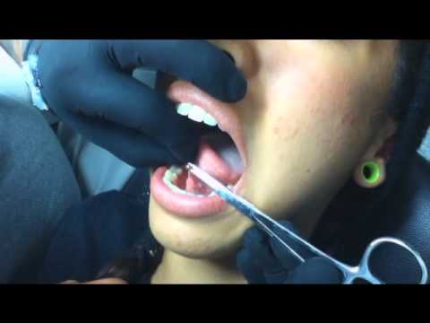 aplicação de piercing no freio da lingua