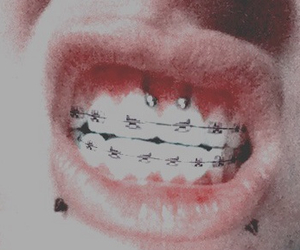 piercing na boca com aparelho odontologico