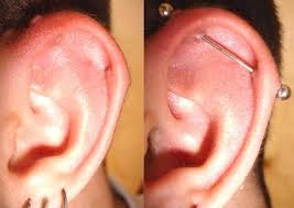 piercing-na-orelha-queloide
