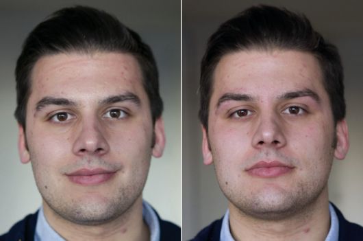 antes e depois rosto redondo