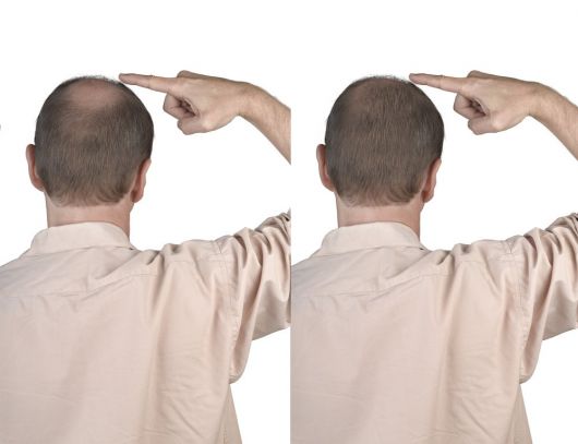 antes e depois hairloss blocker  homem