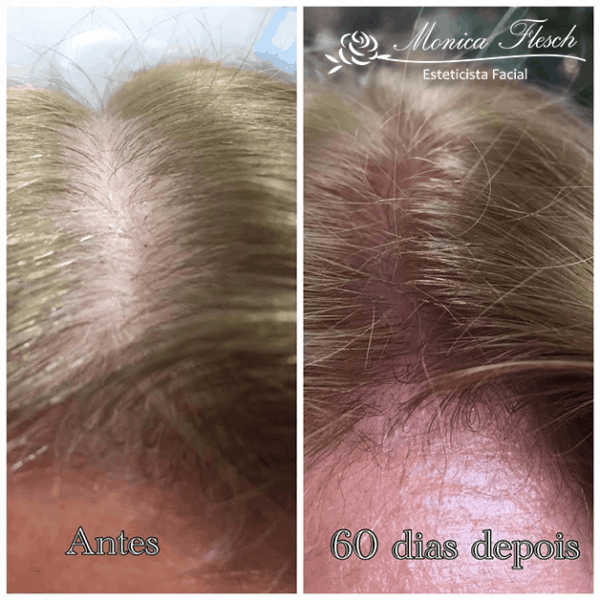 tratamento capilar feminino antes e depois