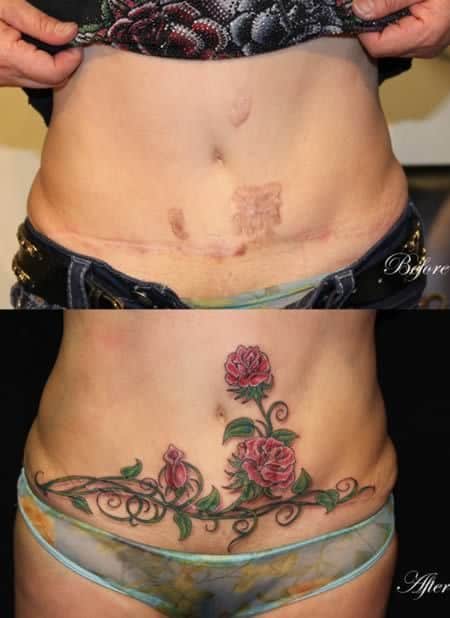 Antes e depois da tatuagem na cicatriz