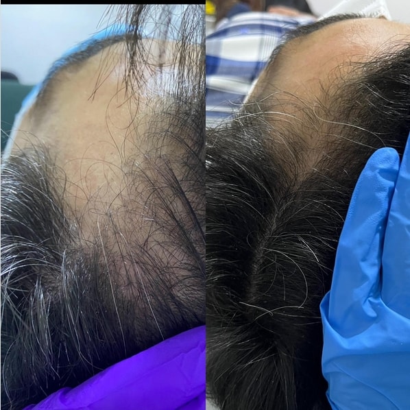 10 antes e depois de mesoterapia capilar @dra ngmedicinaestetica