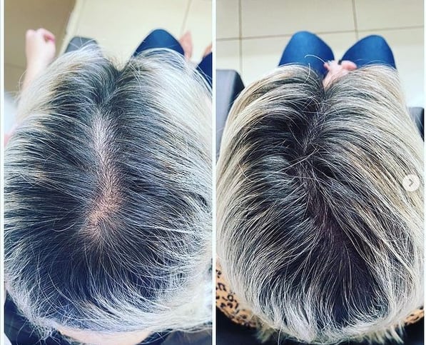 15 resultado de intradermoterapia em cabelo feminino @nacioninienf