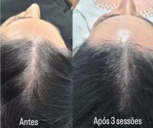 Intradermoterapia Capilar / Mesoterapia – O que é? Como Funciona?