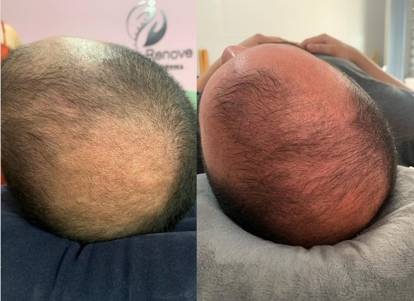 24 antes e depois de mesoterapia capilar masculina @espacorenoveac
